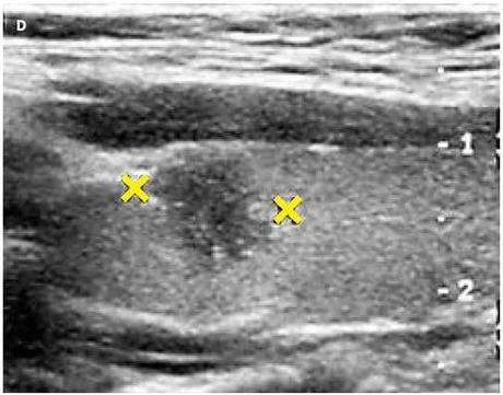 D: Nódulo tiroideo sólido, con microcalcificaciones en el interior y periferia. (Ca papilar).