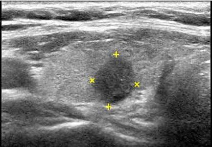 irrigacion de la tiroides y anatomía normal