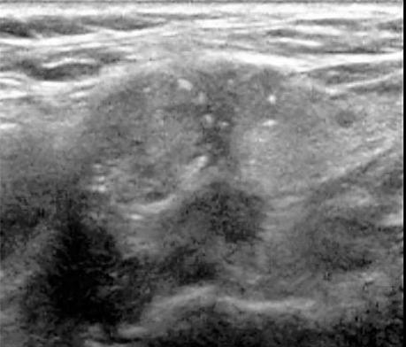 irrigacion de la tiroides y anatomía normal Nódulo sólido con microcalcificaciones y calcificaciones periféricas; el tumor rebasa los límites de las calcificaciones periféricas.
