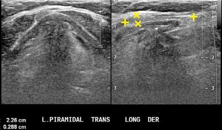 irrigacion de la tiroides y anatomía normal