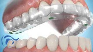 Lo que las Férulas si y no pueden hacer por el paciente