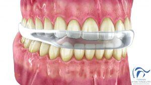 Lo que las Férulas si y no pueden hacer por el paciente