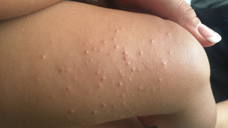 Molluscum Contagiosum : Nuestra experiencia