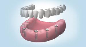 implantes dentales madrid centro Implantes dentales, etapas de colocación.