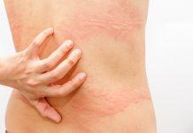 Síndrome de Sjogren: ¿qué se puede hacer sobre las urticaria y otros síntomas de la piel seca?