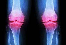 La osteoartritis a menudo afecta las articulaciones de la rodilla