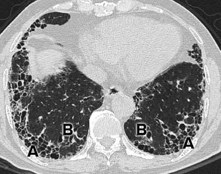 Enfermedad pulmonar intersticial