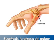Artricenter: Rizartrosis, artrosis pulgar.