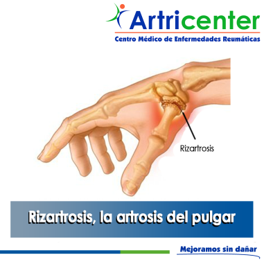Artricenter: Rizartrosis, la artrosis del pulgar.