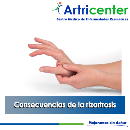 Artricenter: Consecuencias de la rizartrosis Artricenter: Consecuencias de la rizartrosis