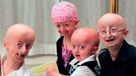 Image result for progeria