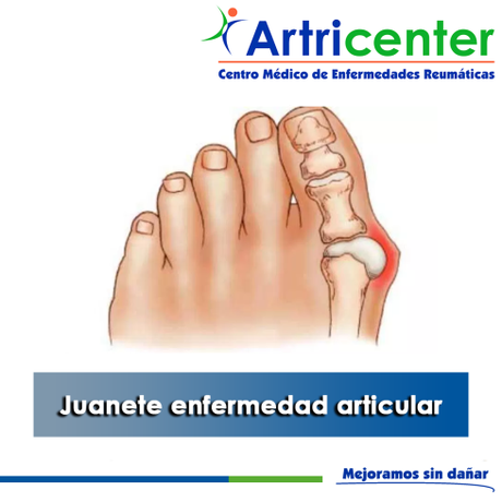 Artricenter: Juanete enfermedad articular.