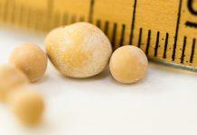 Los cálculos renales pueden variar en tamaño y textura, y están formados por capas de calcio, similares a otros depósitos sedimentarios en la naturaleza