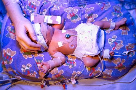 El bebé prematuro El bebé prematuro