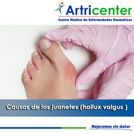 Artricenter: Causas de los juanetes (hallux valgus )