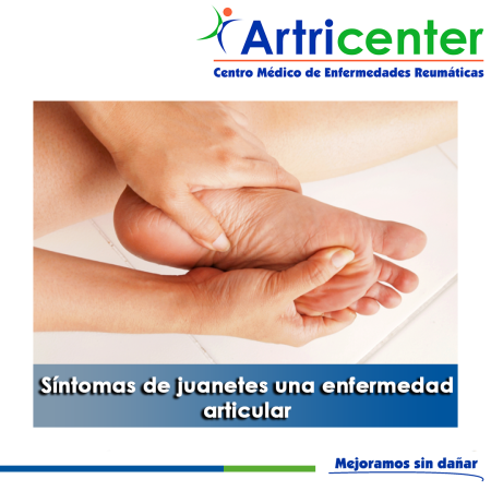 Artricenter: Síntomas de juanetes una enfermedad articular.