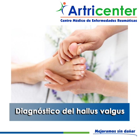 Artricenter:  Diagnóstico del hallus valgus