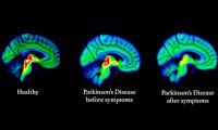 Descubren los Primeros Signos del Parkinson en el Cerebro