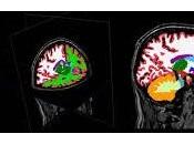 Científicos identifican genes alto riesgo para esquizofrenia