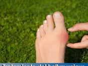 Artricenter: Tratamiento hallux valgus juanete