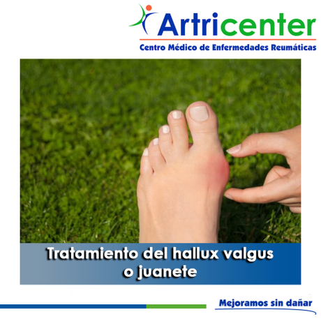 Artricenter: Tratamiento del hallux valgus o juanete Artricenter: Tratamiento del hallux valgus o juanete