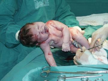 El parto por cesárea o parto abdominal El parto por cesárea o parto abdominal