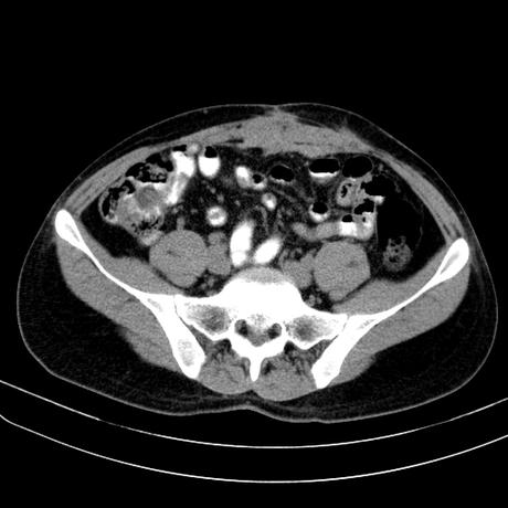 POST OPERADO DE PLASTIA ABDOMINAL