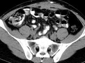 Post operado plastia abdominal