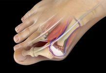 ¿Cuál es la mejor manera de deshacerse de un juanete? Un médico evaluará el juanete antes de recomendar un tipo de cirugía