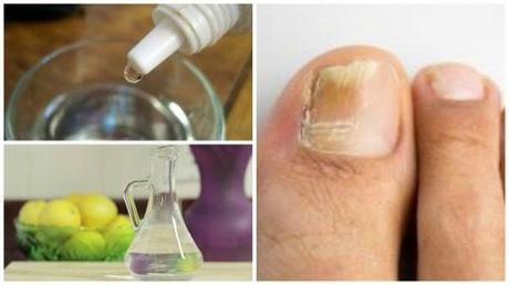 10 remedios para eliminar la onicomicosis (hongos en las uñas del pie) onicomicosis tratamiento