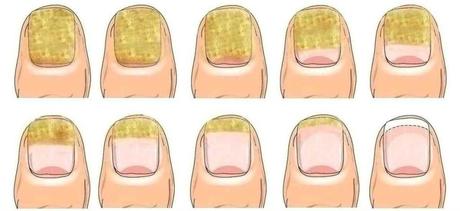 10 remedios para eliminar la onicomicosis (hongos en las uñas del pie) tratamiento onicomicosis