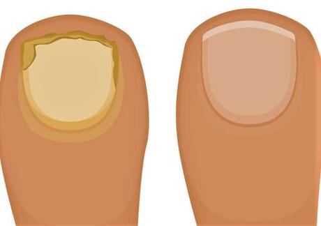 10 remedios para eliminar la onicomicosis (hongos en las uñas del pie) onicomicosis