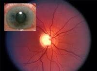 Usando Regeneración Ganglionar se puede Curar el Glaucoma