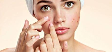 Vitacilina para tratar el acné