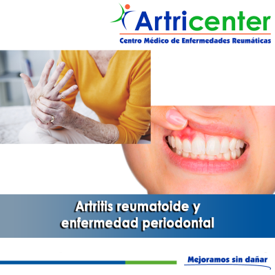 Artricenter: Artritis reumatoide y enfermedad periodontal.