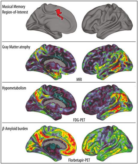 El Alzheimer no Puede con el Área del Cerebro que Guarda la Música