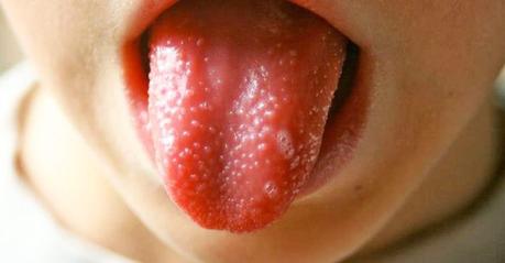 Granos en la lengua Granos en la lengua en niños