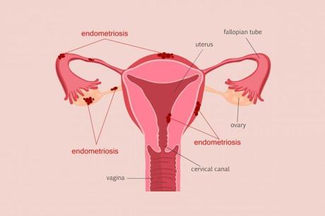 Endometriosis – Naturópata en Madrid