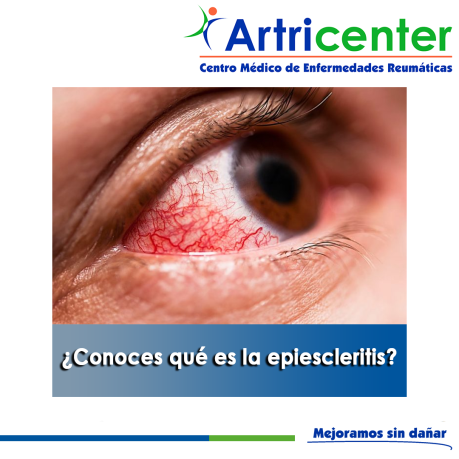 Artricenter: ¿Conoces qué es la epiescleritis?