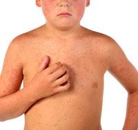 Avanzan en el desarrollo de un Medicamento contra el Prurito