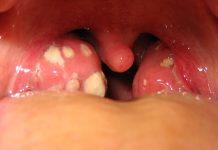 Tratamiento para las piedras en las amígdalas: ¿cómo curar tonsilolitos?