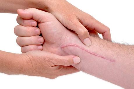 Tejido cicatricial: causas, prevención y tratamiento