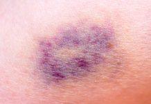 Moretones que salen fácilmente