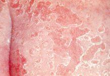 Candida es un tipo de levadura que causa una infección por hongos en el cuerpo