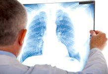 La enfermedad pulmonar puede aumentar el riesgo de demencia Para limitar el riesgo de demencia, las personas también pueden querer cuidar la salud de sus pulmones, sugiere un estudio reciente