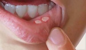 Las postemillas causas y remedios