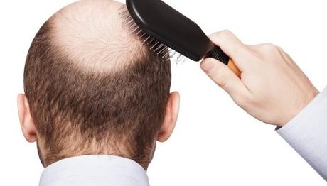 Pérdida De Cabello: ¿Puede La Caspa Causar Pérdida De Cabello? ¿Cómo se relacionan la caspa y la caída del cabello?