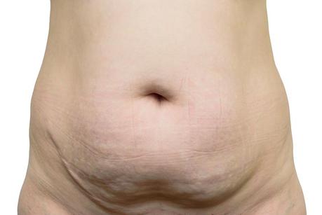 La celulitis en el embarazo