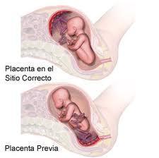 ¿Que es la placenta previa?