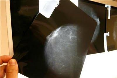Las mamografías reduce  un 30% la mortalidad por cáncer de mama